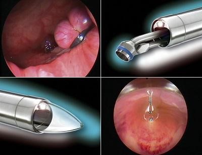 Liệu pháp điều trị cho người bị bệnh trĩ